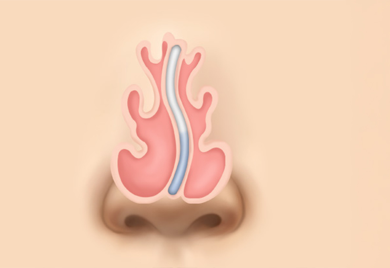 비중격만곡증 교정