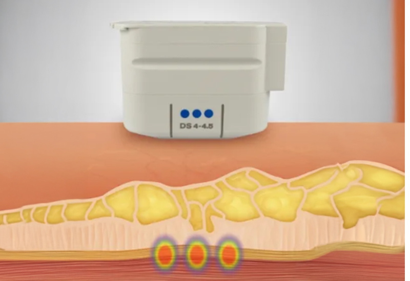 일정하고 균일한 리프팅 효과