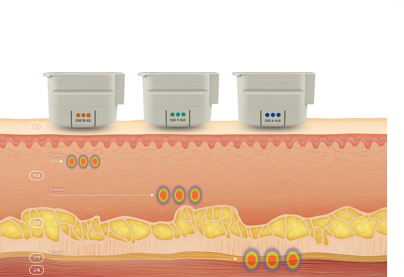 피부층에 맞게 시술